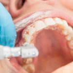 Dental Cleaning