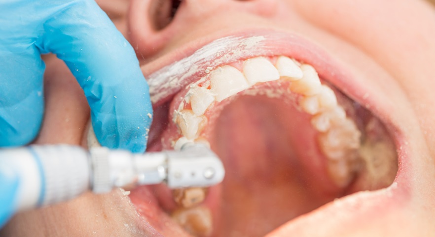 How Often is a Dental Cleaning Needed?